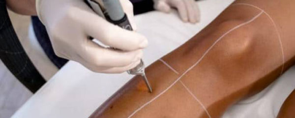 Épilation laser pour peaux noires
