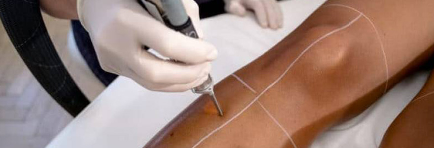 Épilation laser pour peaux noires